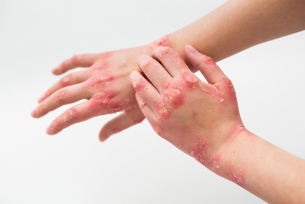 Treating Eczema With Homeopathy